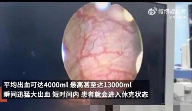 郑州女子6次剖宫产分娩，已经是5个孩子的妈