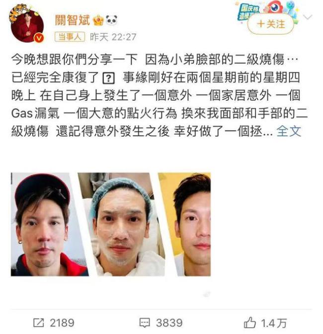 港星关智斌自曝煤气漏气致面部手部二级烧伤
