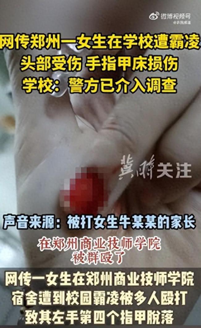 网传河南一女生遭多人霸凌指甲被打脱落 学校称警方已介入调查