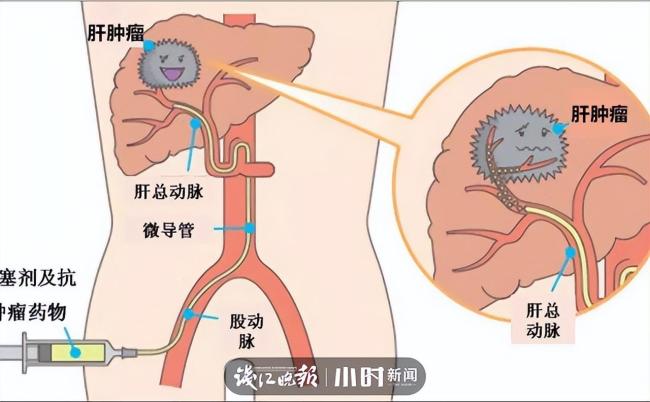 女子节食暴瘦44斤想“饿死”肿瘤，“饥饿疗法”靠谱吗？