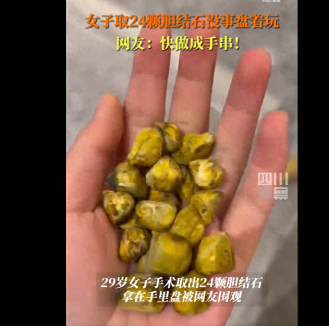 重庆29岁女生取24颗胆结石没事盘着玩称颜色非常有光泽很有趣