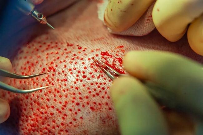 被脱发困住的中年男人正积极自救，真的能解决吗？