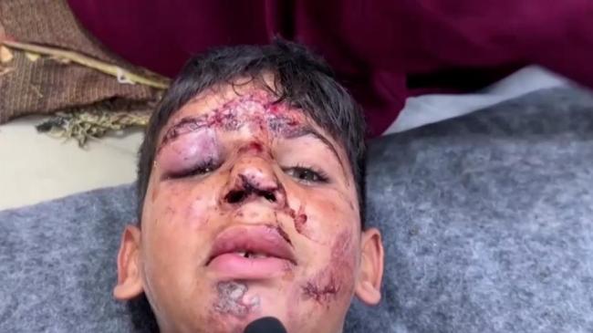 加沙受伤儿童被迫无麻醉截肢 数百童肢残，危机深重