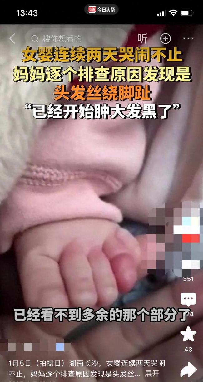 女婴两天哭闹不止竟头发丝绕脚趾 细发缠足致肿胀