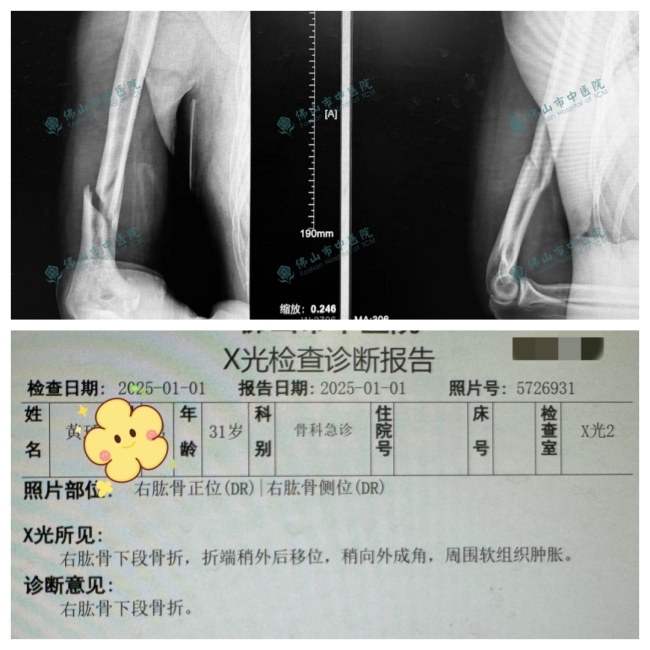 两小伙与机器人扳手腕当场骨折 游乐设施隐患需警惕