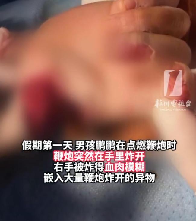 男孩玩鞭炮食指被炸只剩骨头 医生：手眼最易中招，近期高发