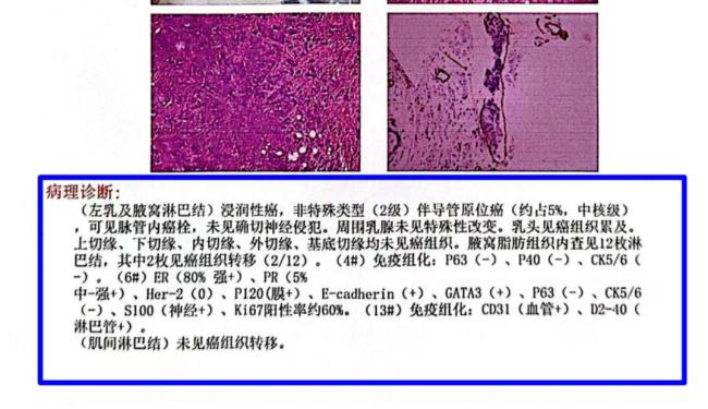 58歲男子確診乳腺癌 小疙瘩竟是惡疾