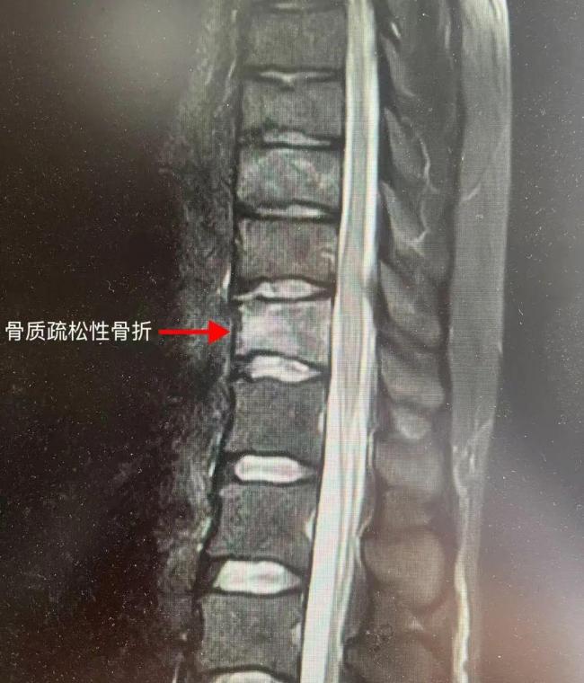 女子每天4杯咖啡喝出骨质疏松 过量咖啡影响钙吸收