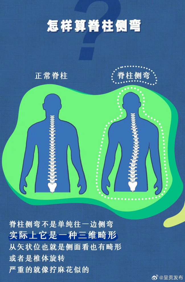 孩子脊柱侧弯了还以为是体态不好 家长需警惕的健康隐患