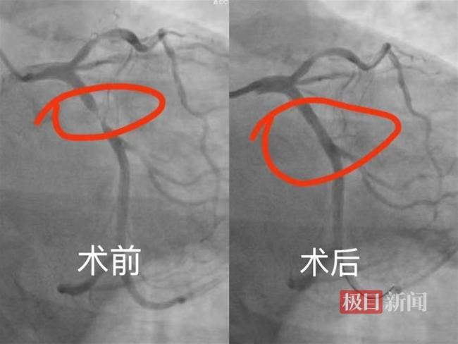 患者在门诊突发心梗 医生35分钟救治 生死时速创奇迹