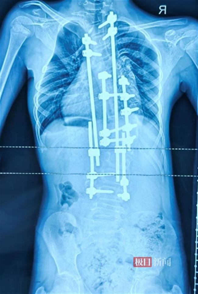 11歲女孩脊柱側(cè)彎成C字 手術(shù)助她挺直脊梁