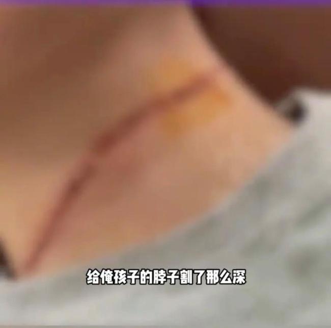 又到风筝季，2天3起“割喉”！17岁男孩被风筝线割伤脖子缝21针