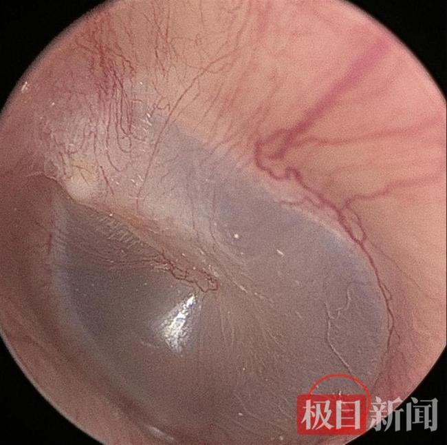 男子長期和貓同睡耳中長出貓螨蟲