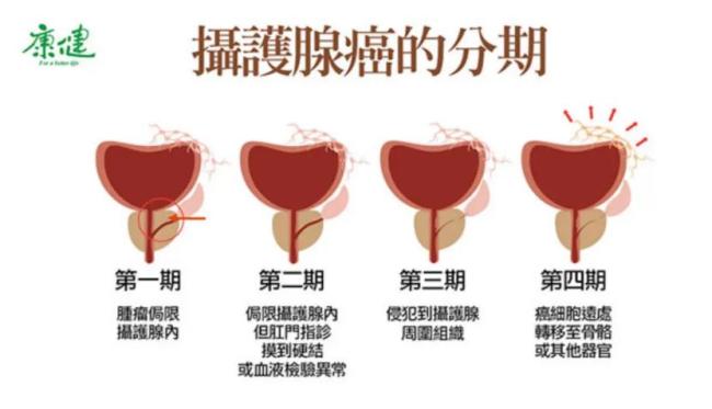 拜登确诊前列腺癌是体检不到位吗 家族癌症史再添一例