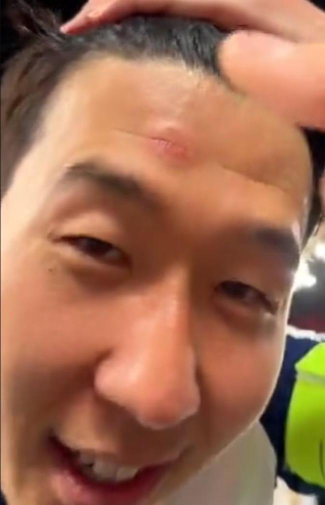 孫興慜被獎杯撞破頭