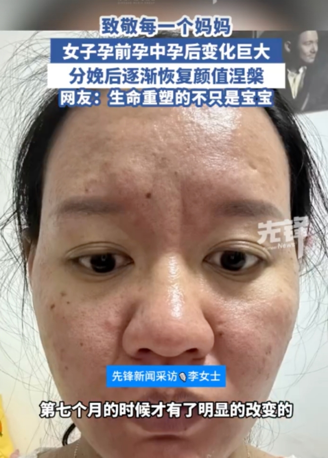 女子分享孕期分娩后容貌變化 孕激素下的變形記