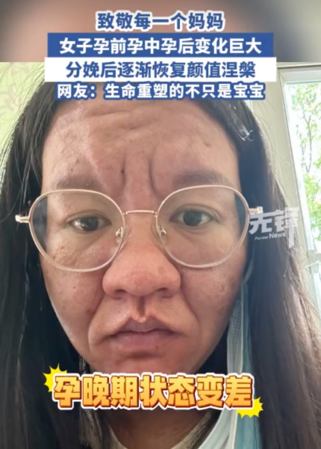 女子分享孕中孕晚分娩后容貌變化 孕激素下的變形記