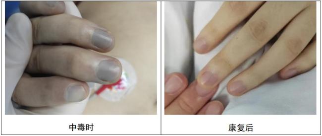 小伙亞硝酸鹽中毒 尿液呈藍色 解毒劑亞甲藍起效