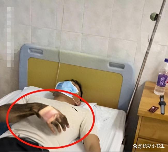 男子野外抓蛇被咬后手变黑肿胀