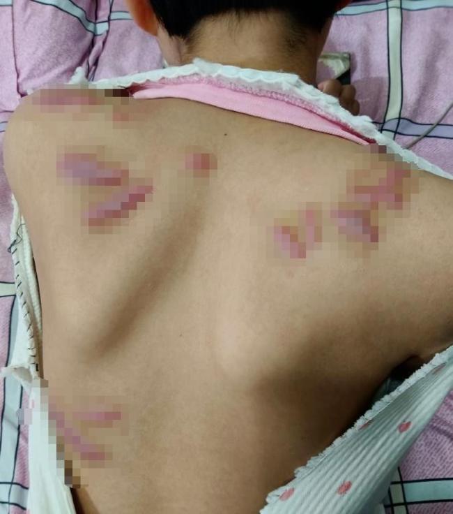 9歲女孩被未滿14歲男孩砍傷