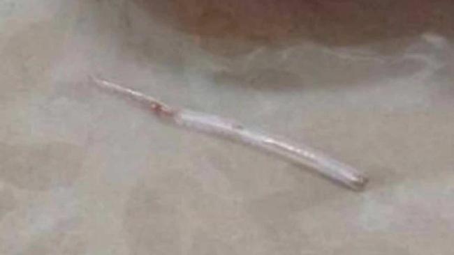 泰国女子吃鱼被鱼刺扎穿脖子 按摩痛处引发意外