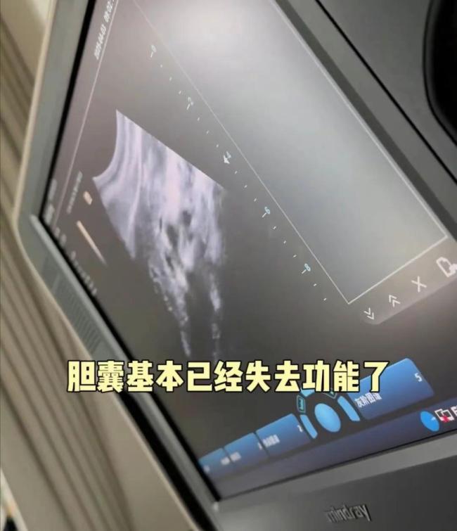 穎兒分享割膽手術(shù)經(jīng)歷 醫(yī)生提醒 關(guān)注膽囊健康