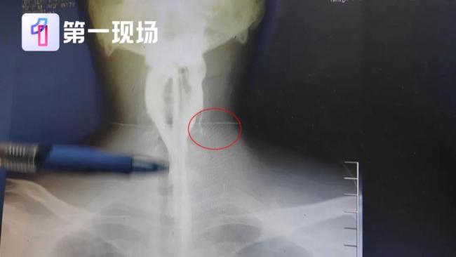 小伙脖子腫痛開刀取出7顆瓜子 罕見病梨狀窩瘺作祟