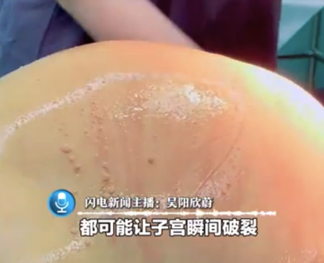 女子連續(xù)3次剖宮產(chǎn)生娃后又懷孕 子宮破裂險些喪失