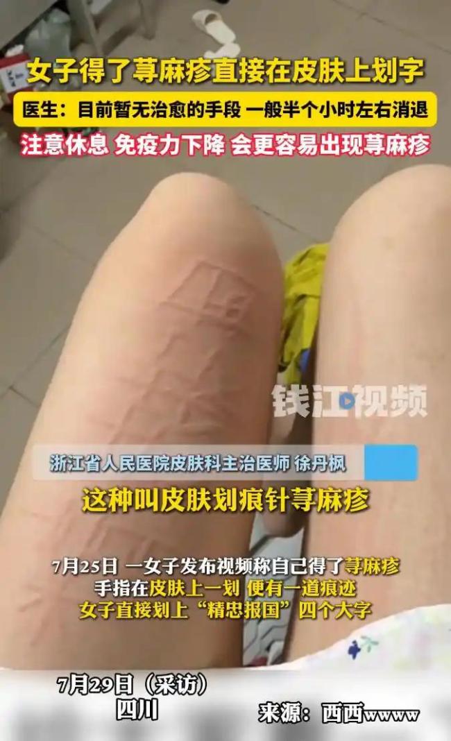 醫(yī)生談患蕁麻疹能在皮膚劃字 皮膚劃痕癥可藥物緩解
