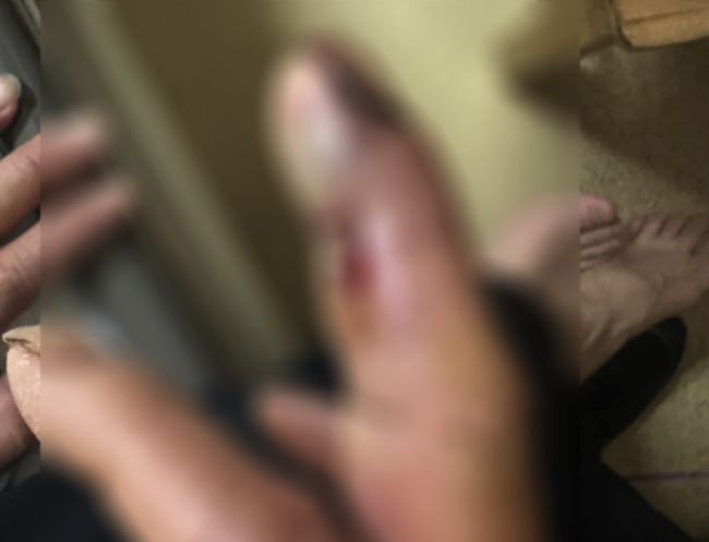 男子听信偏方徒手抓它泡酒反被咬，毒素迅速扩撒