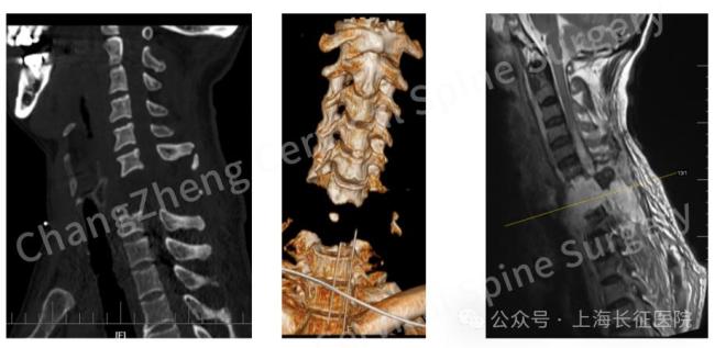 全球罕见！中国医生救回“身首离断”患者