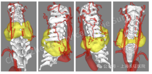 全球罕见！“身首离断”患者被救回 中国医生挑战“不可能”