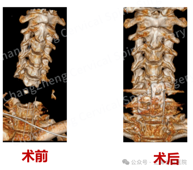 全球罕见！“身首离断”患者被救回 中国医生挑战“不可能”