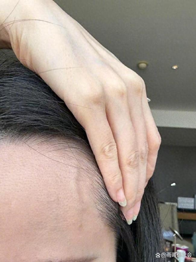 顶流女星突患疾病？张靓颖一伸懒腰手掌就流血