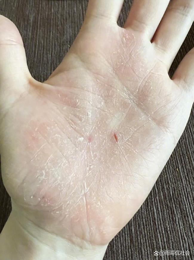 顶流女星突患疾病？张靓颖一伸懒腰手掌就流血