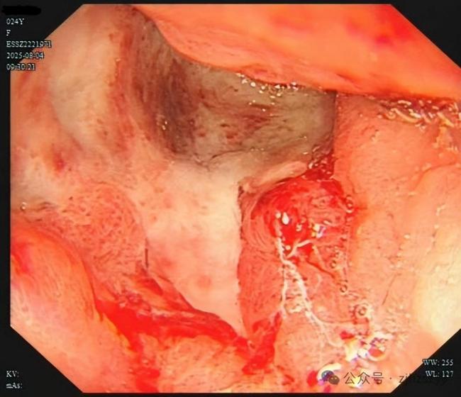 00后短剧女演员确诊胃癌 高压工作下的健康警示