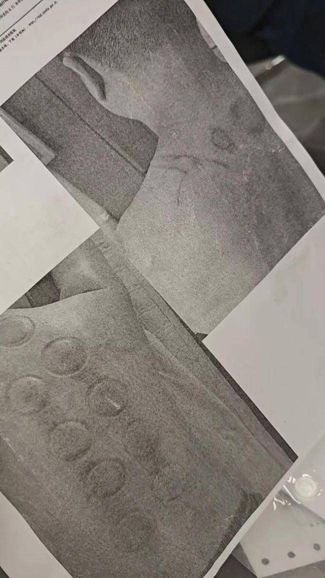 足浴店拔罐 二度烧伤：操作不当导致酒精酒落在背部