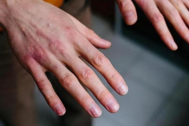 大一男生感染艾滋后发声，对方看着很健康