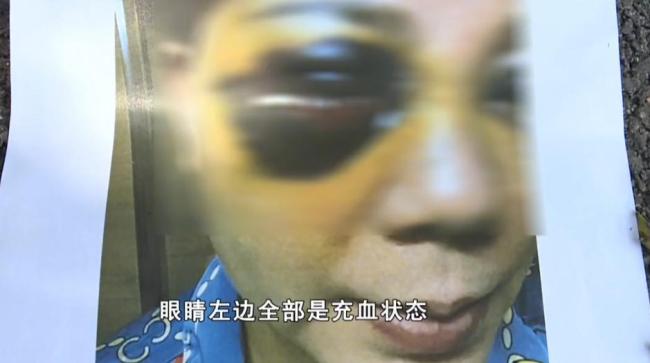 58岁女子整容后肿成熊猫 追求美丽需谨慎