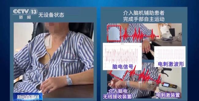 我國腦機接口技術(shù)走向臨床 受試者體驗如何？