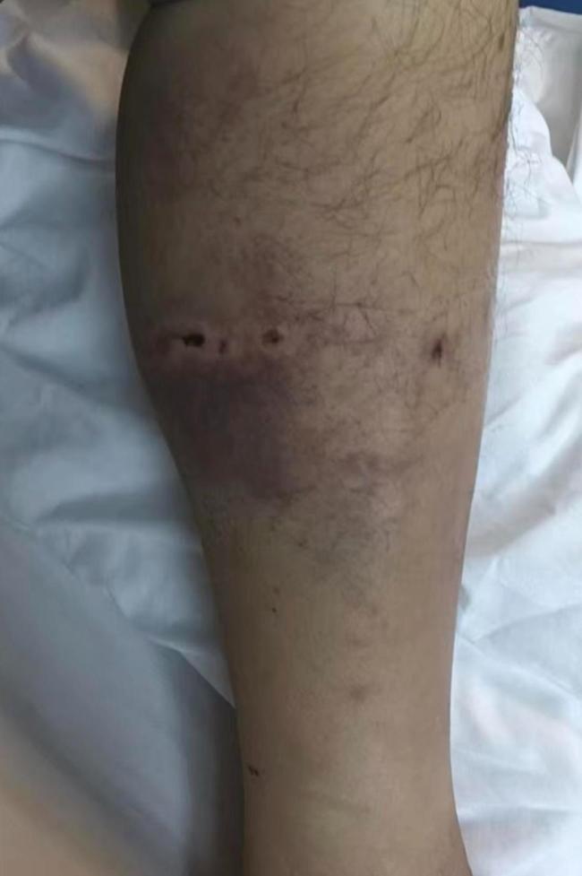 遭熊袭击男子称雨靴救了自己一命 山中惊魂逃生记