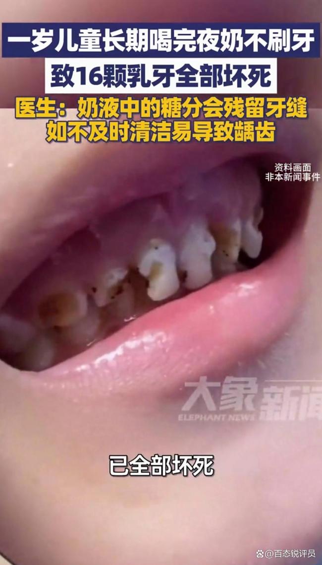 16个坏死的牙齿，由16个儿童在不刷牙的情