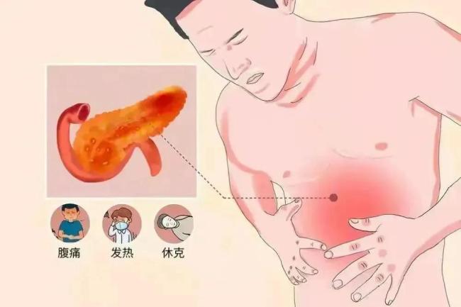 男子体内抽出牛奶血 这样吃饭危害大 高脂饮食引发胰腺炎