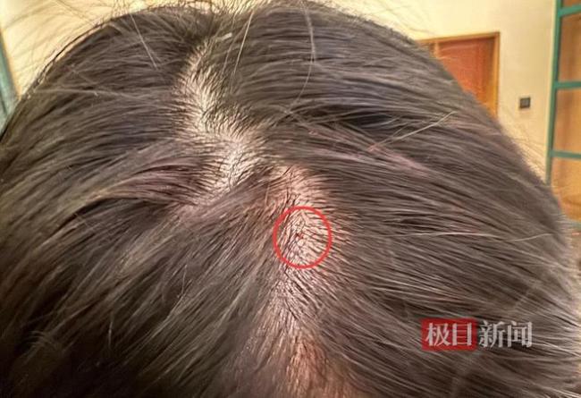 酒店称扎破女子头的钉子来源不明 已安排专人处理