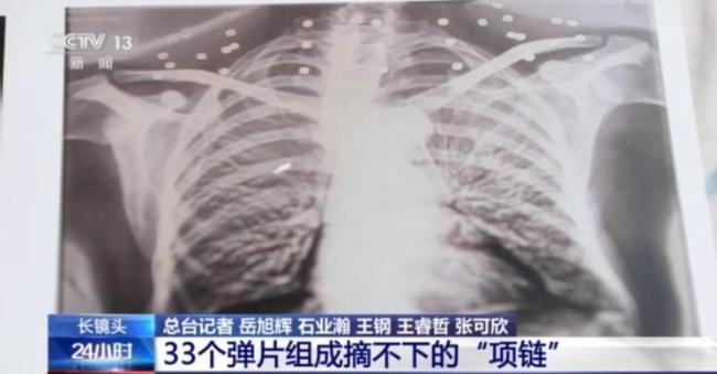33个弹片成为老兵摘不掉的“项链”