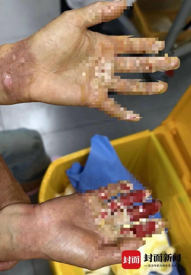 烧烤店内一男童不慎掉进炭堆，全身烧伤 安全防护缺失引发悲剧