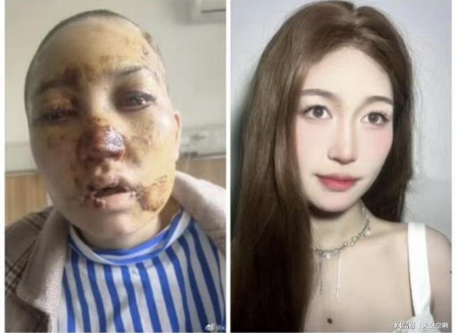 浙江公厕被打女孩称确诊白血病 家庭再陷困境