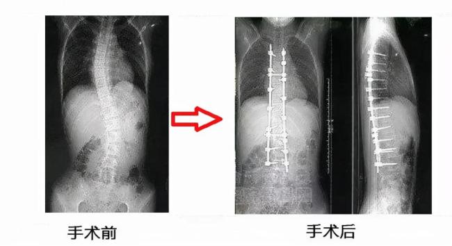 1亿多年轻人正被这病虐待 脊柱问题年轻化警钟