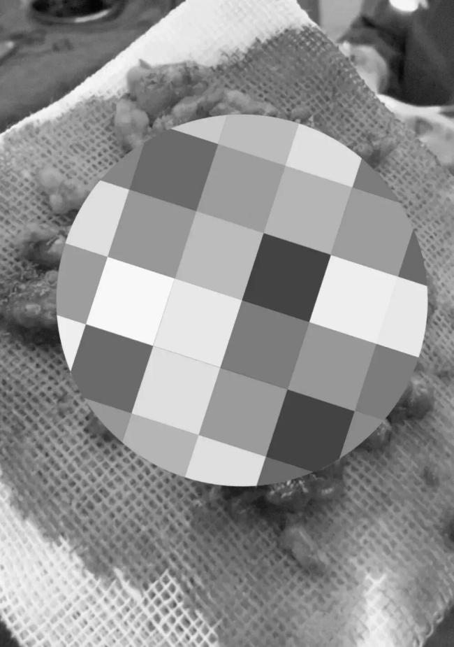 一针毁容！成本20元的表皮生长因子售价上万 非法注射陷阱深