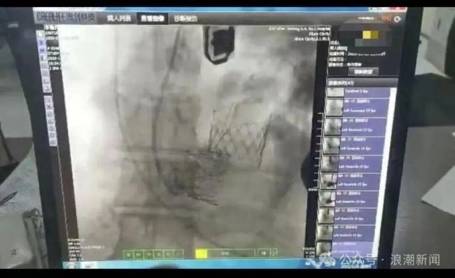 心臟瓣膜“出廠價3萬醫(yī)院收28萬